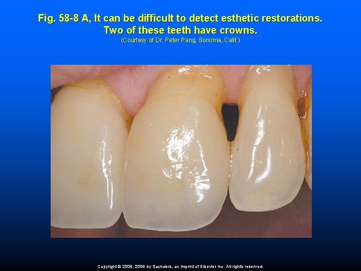 Fig. 58 -8 A, It can be difficult to detect esthetic restorations. Two of