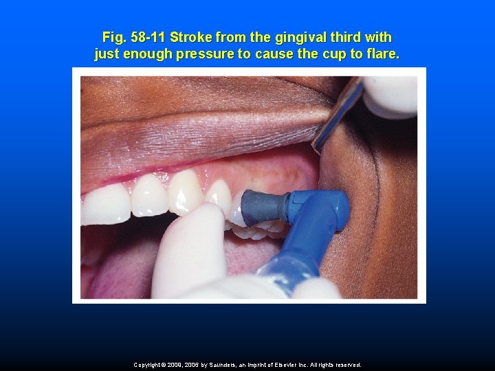 Fig. 58 -11 Stroke from the gingival third with just enough pressure to cause