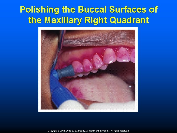Polishing the Buccal Surfaces of the Maxillary Right Quadrant Copyright © 2009, 2006 by