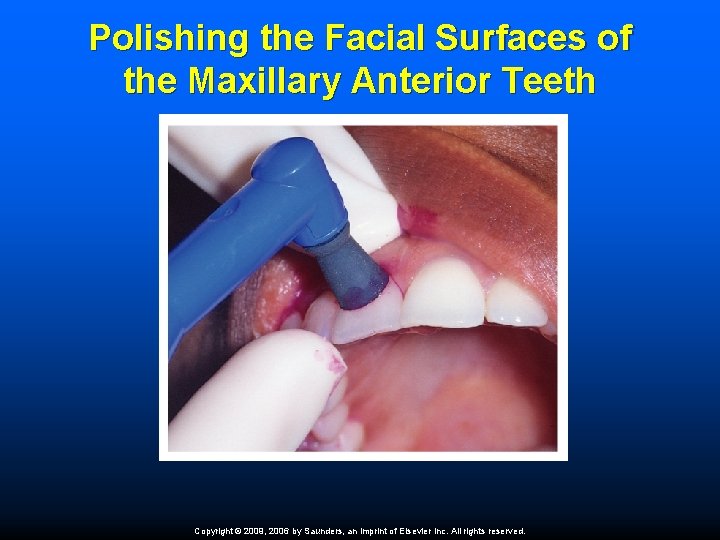 Polishing the Facial Surfaces of the Maxillary Anterior Teeth Copyright © 2009, 2006 by