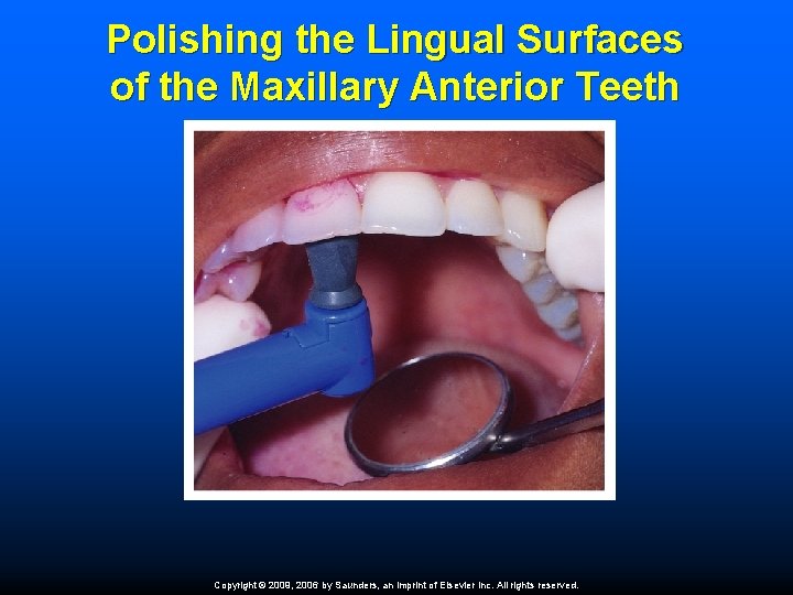 Polishing the Lingual Surfaces of the Maxillary Anterior Teeth Copyright © 2009, 2006 by