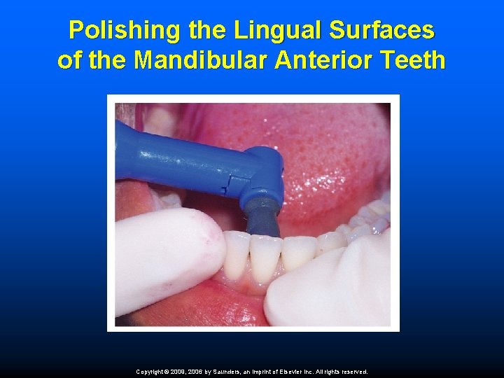 Polishing the Lingual Surfaces of the Mandibular Anterior Teeth Copyright © 2009, 2006 by