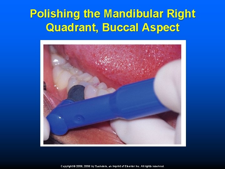 Polishing the Mandibular Right Quadrant, Buccal Aspect Copyright © 2009, 2006 by Saunders, an