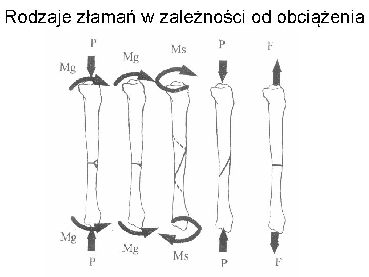 Rodzaje złamań w zależności od obciążenia 