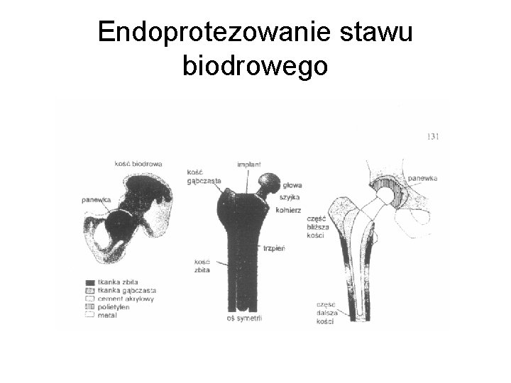 Endoprotezowanie stawu biodrowego 