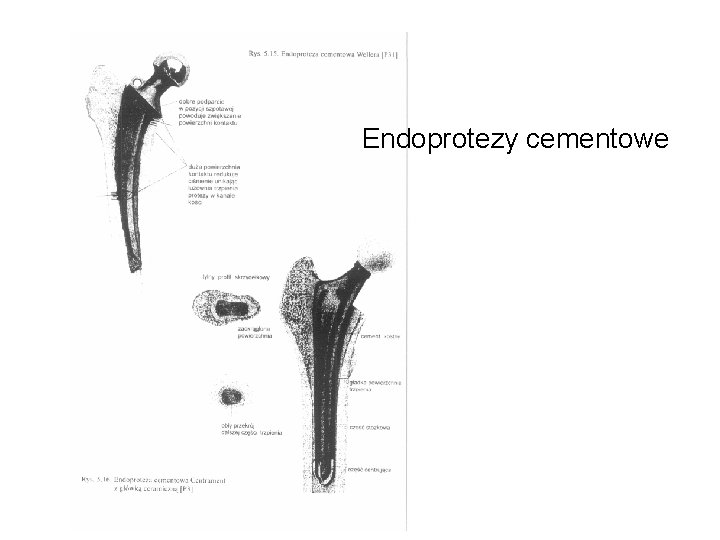 Endoprotezy cementowe 