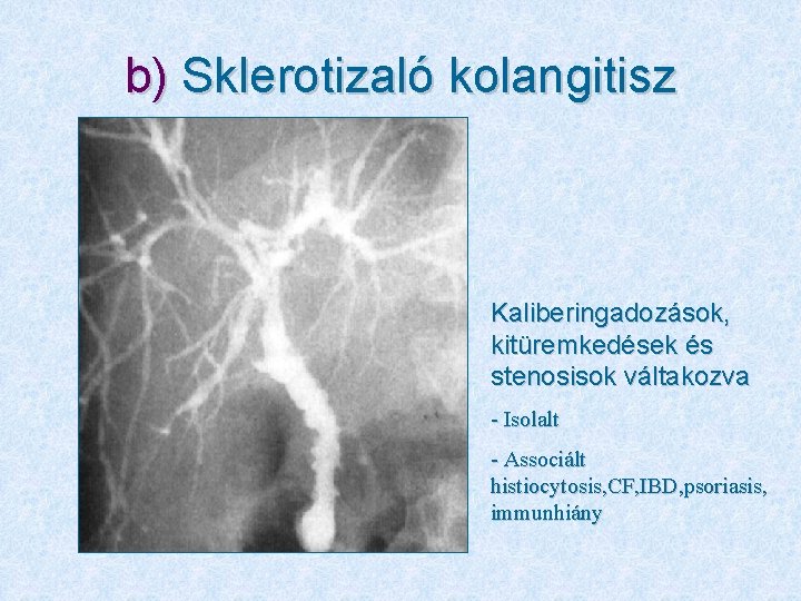 b) Sklerotizaló kolangitisz Kaliberingadozások, kitüremkedések és stenosisok váltakozva - Isolalt - Associált histiocytosis, CF,