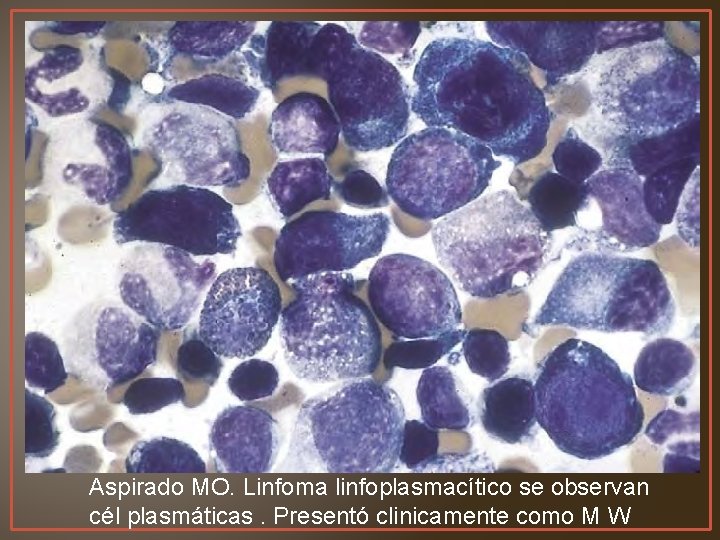 Aspirado MO. Linfoma linfoplasmacítico se observan cél plasmáticas. Presentó clinicamente como M W 