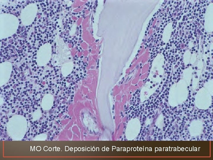 MO Corte. Deposición de Paraproteína paratrabecular 