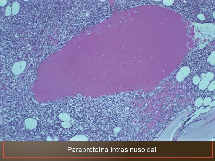 Paraproteína intrasinusoidal 