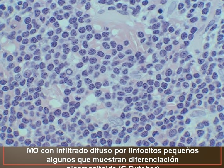 MO con infiltrado difuso por linfocitos pequeños algunos que muestran diferenciación 