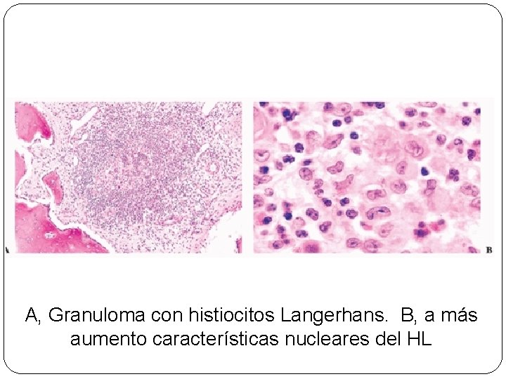 A, Granuloma con histiocitos Langerhans. B, a más aumento características nucleares del HL 