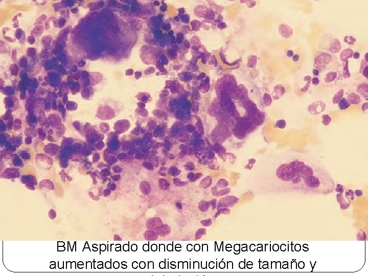 BM Aspirado donde con Megacariocitos aumentados con disminución de tamaño y 