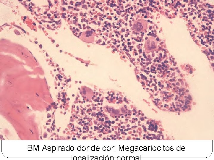 BM Aspirado donde con Megacariocitos de 