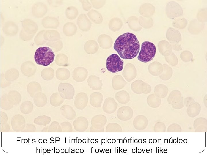 Frotis de SP. Linfocitos pleomórficos con núcleo hiperlobulado –flower-like, clover-like 
