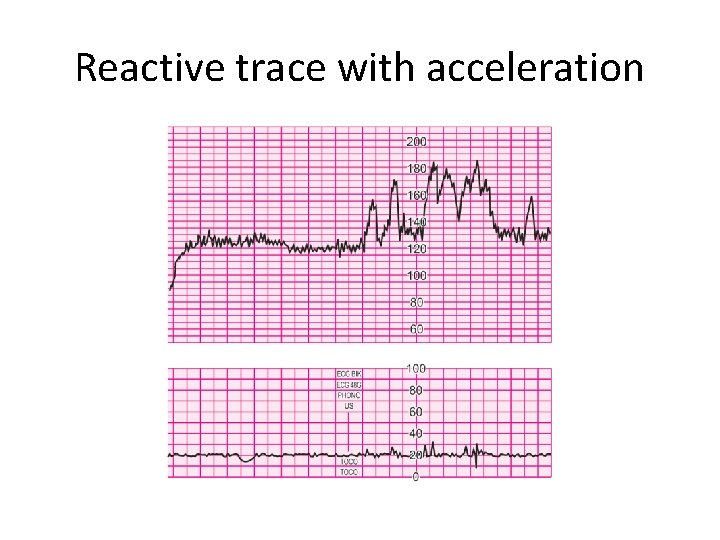 Reactive trace with acceleration 