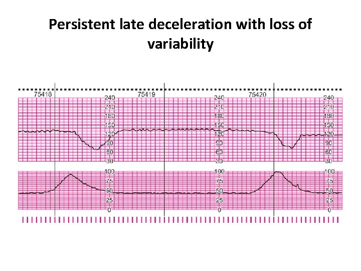 Persistent late deceleration with loss of variability 
