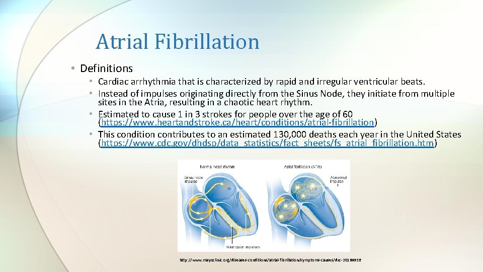 Atrial Fibrillation • Definitions • Cardiac arrhythmia that is characterized by rapid and irregular Atrial Fibrillation • Definitions • Cardiac arrhythmia that is characterized by rapid and irregular