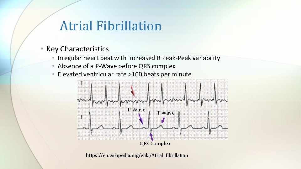 Atrial Fibrillation • Key Characteristics • Irregular heart beat with increased R Peak-Peak variability Atrial Fibrillation • Key Characteristics • Irregular heart beat with increased R Peak-Peak variability