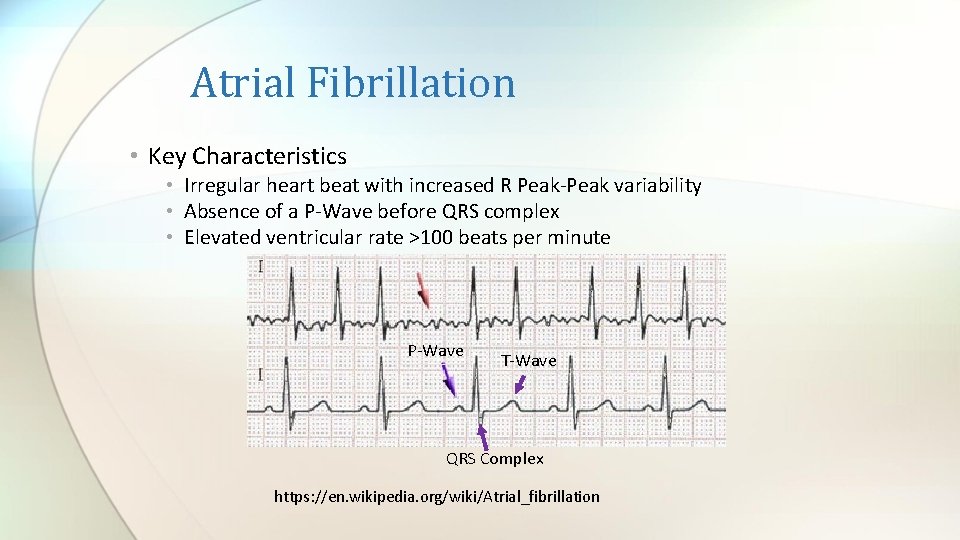 Atrial Fibrillation • Key Characteristics • Irregular heart beat with increased R Peak-Peak variability