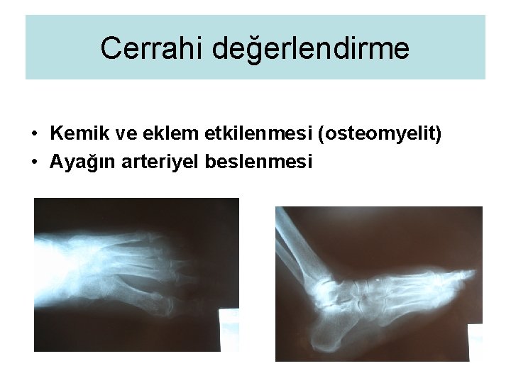 Cerrahi değerlendirme • Kemik ve eklem etkilenmesi (osteomyelit) • Ayağın arteriyel beslenmesi 