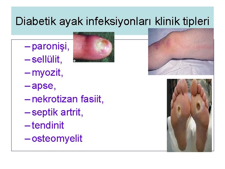 Diabetik ayak infeksiyonları klinik tipleri – paronişi, – sellülit, – myozit, – apse, –