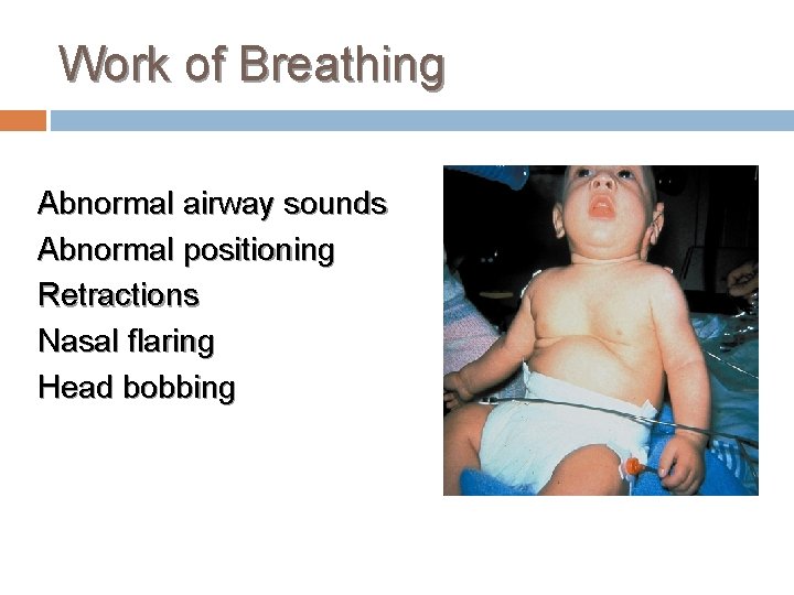 Work of Breathing Abnormal airway sounds Abnormal positioning Retractions Nasal flaring Head bobbing 