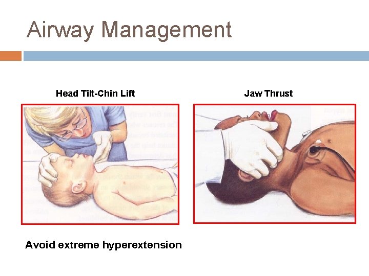 Airway Management Head Tilt-Chin Lift Avoid extreme hyperextension Jaw Thrust 