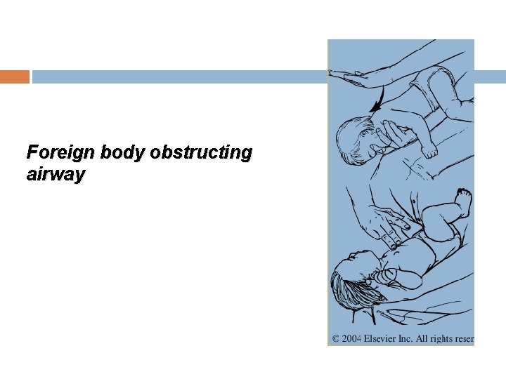 Foreign body obstructing airway 