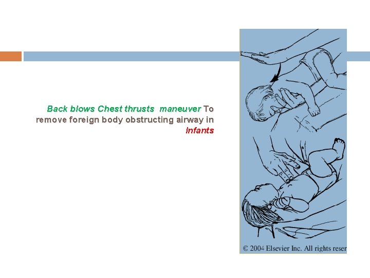 Back blows Chest thrusts maneuver To remove foreign body obstructing airway in Infants 