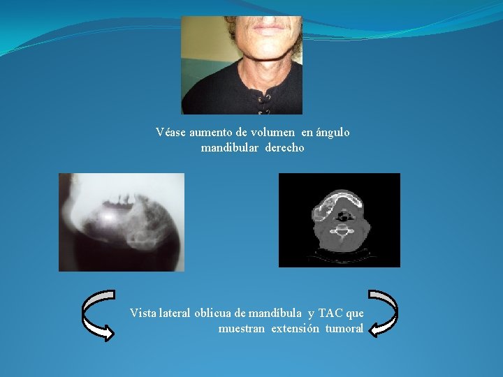 Véase aumento de volumen en ángulo mandibular derecho Vista lateral oblicua de mandíbula y