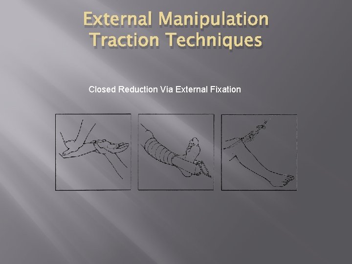 External Manipulation Traction Techniques Closed Reduction Via External Fixation 