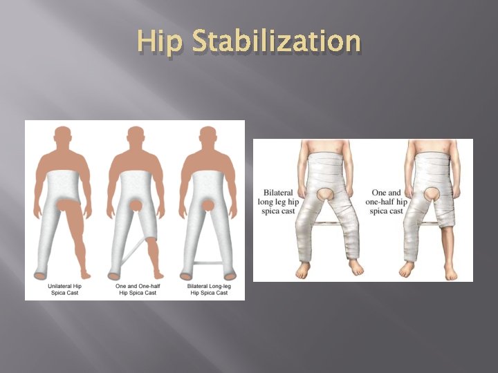 Hip Stabilization 