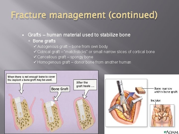 Fracture management (continued) § Grafts – human material used to stabilize bone Bone grafts