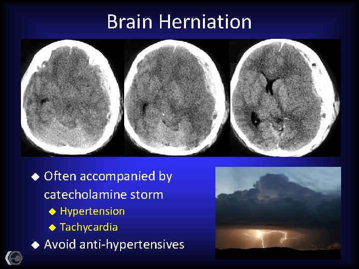 Brain Herniation u Often accompanied by catecholamine storm Hypertension u Tachycardia u u Avoid