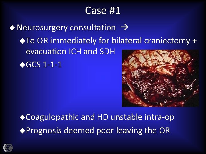 Case #1 u Neurosurgery consultation u. To OR immediately for bilateral craniectomy + evacuation