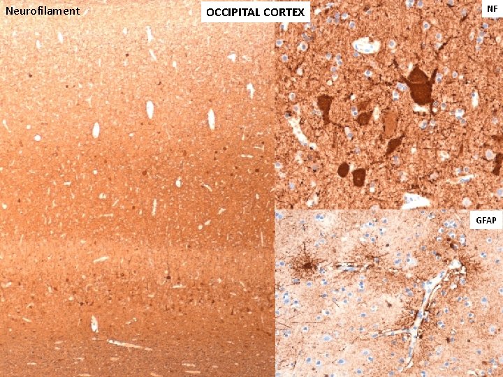 Neurofilament OCCIPITAL CORTEX NF , GFAP 