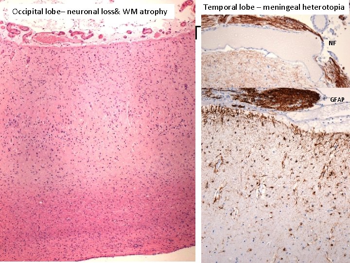 Occipital lobe– neuronal loss& WM atrophy Temporal lobe – meningeal heterotopia HE HETERTOPIA NF