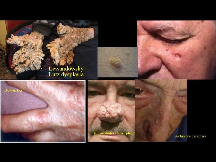  • Lewandowsky. Lutz dysplasia Bowen kór Rhinophima - krumpliorr Actinicus ceratosis 