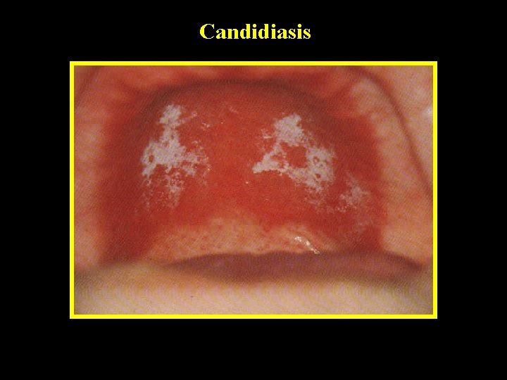 Candidiasis 