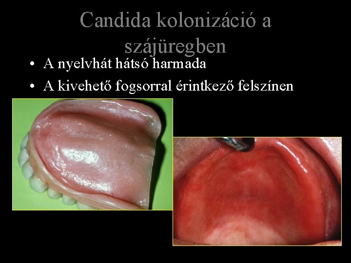 Candida kolonizáció a szájüregben • A nyelvhát hátsó harmada • A kivehető fogsorral érintkező