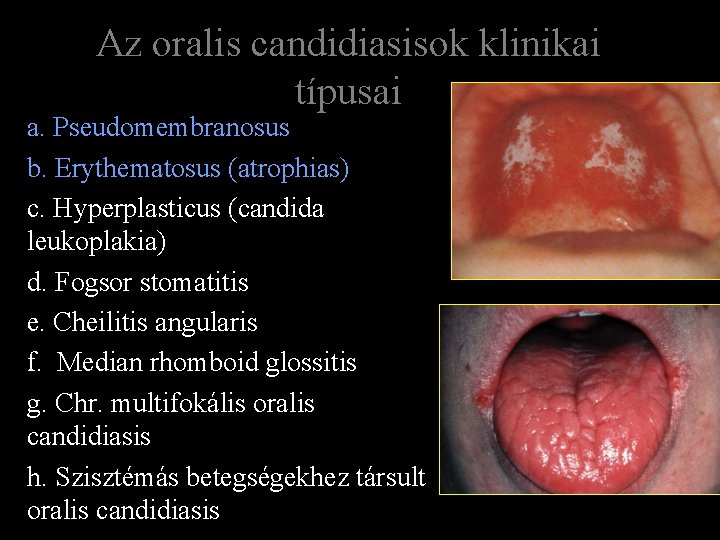 Az oralis candidiasisok klinikai típusai a. Pseudomembranosus b. Erythematosus (atrophias) c. Hyperplasticus (candida leukoplakia)