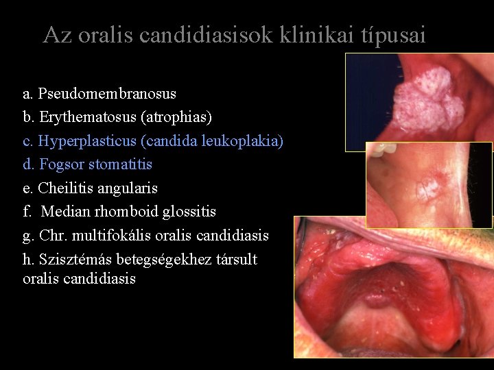 Az oralis candidiasisok klinikai típusai a. Pseudomembranosus b. Erythematosus (atrophias) c. Hyperplasticus (candida leukoplakia)