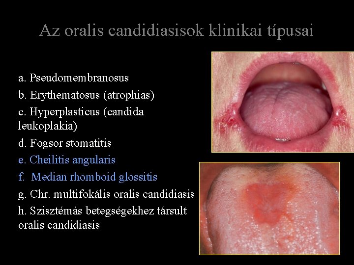 Az oralis candidiasisok klinikai típusai a. Pseudomembranosus b. Erythematosus (atrophias) c. Hyperplasticus (candida leukoplakia)