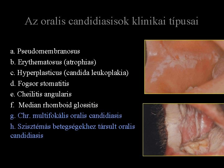 Az oralis candidiasisok klinikai típusai a. Pseudomembranosus b. Erythematosus (atrophias) c. Hyperplasticus (candida leukoplakia)