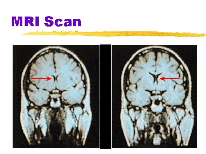 MRI Scan 