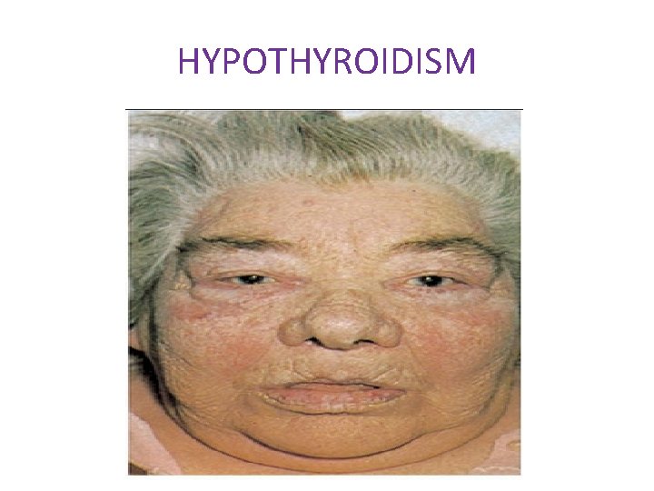 HYPOTHYROIDISM 
