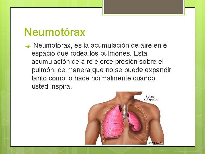 Neumotórax, es la acumulación de aire en el espacio que rodea los pulmones. Esta