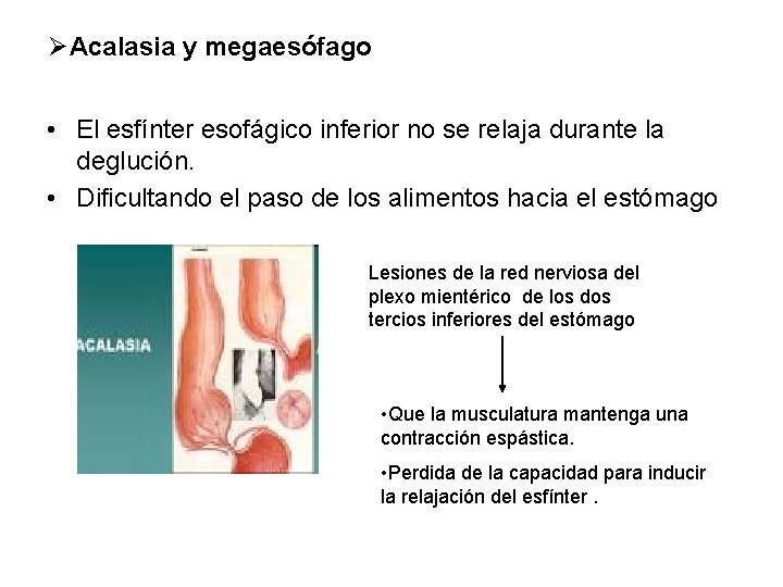 ØAcalasia y megaesófago • El esfínter esofágico inferior no se relaja durante la deglución.