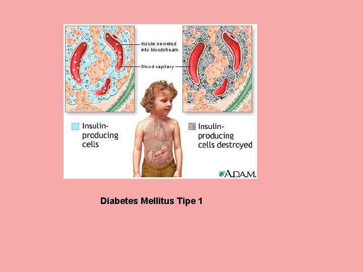 Diabetes Mellitus Tipe 1 
